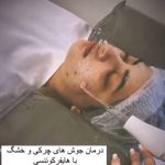 فشیال و جوانسازی پوست